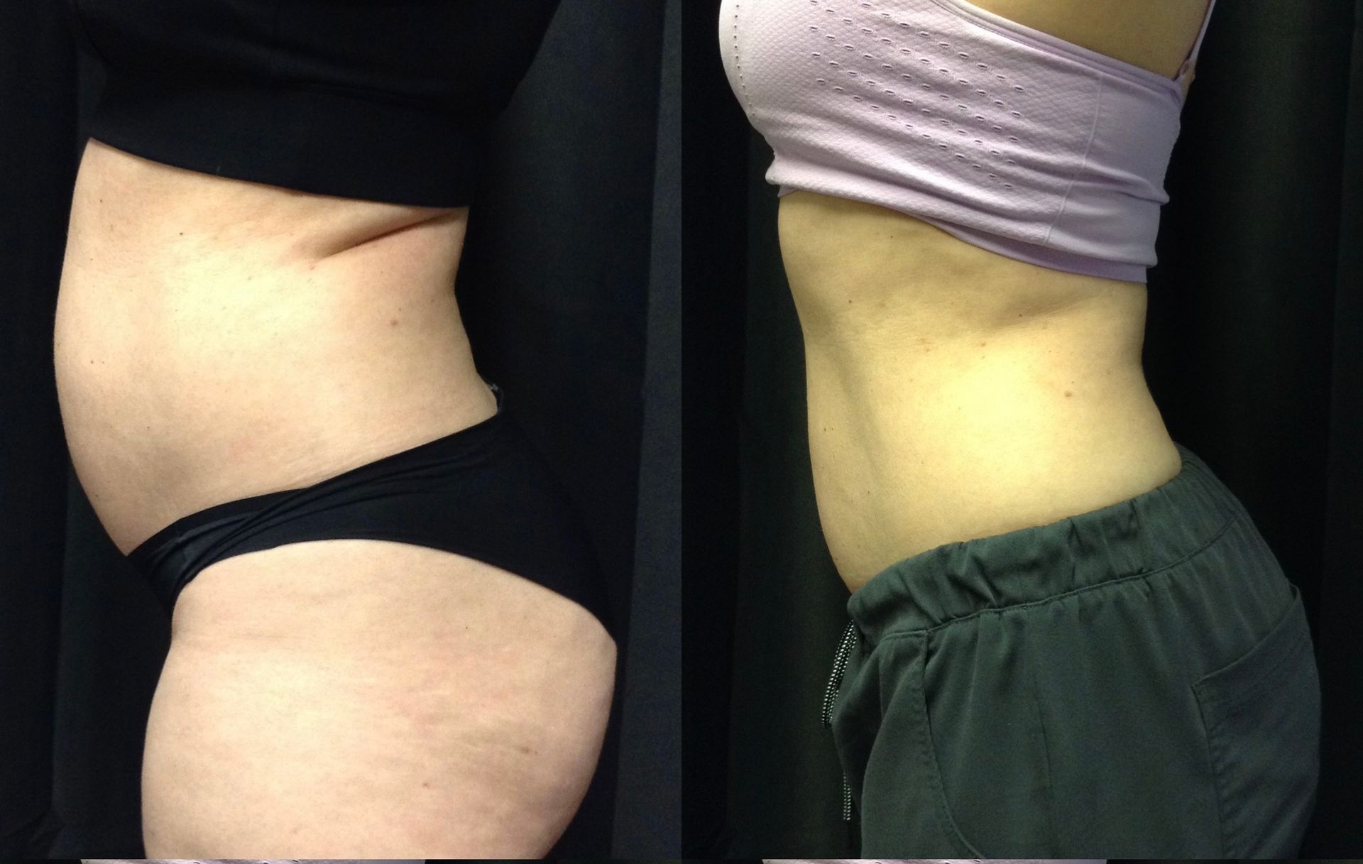 A before and after picture of a woman 's stomach