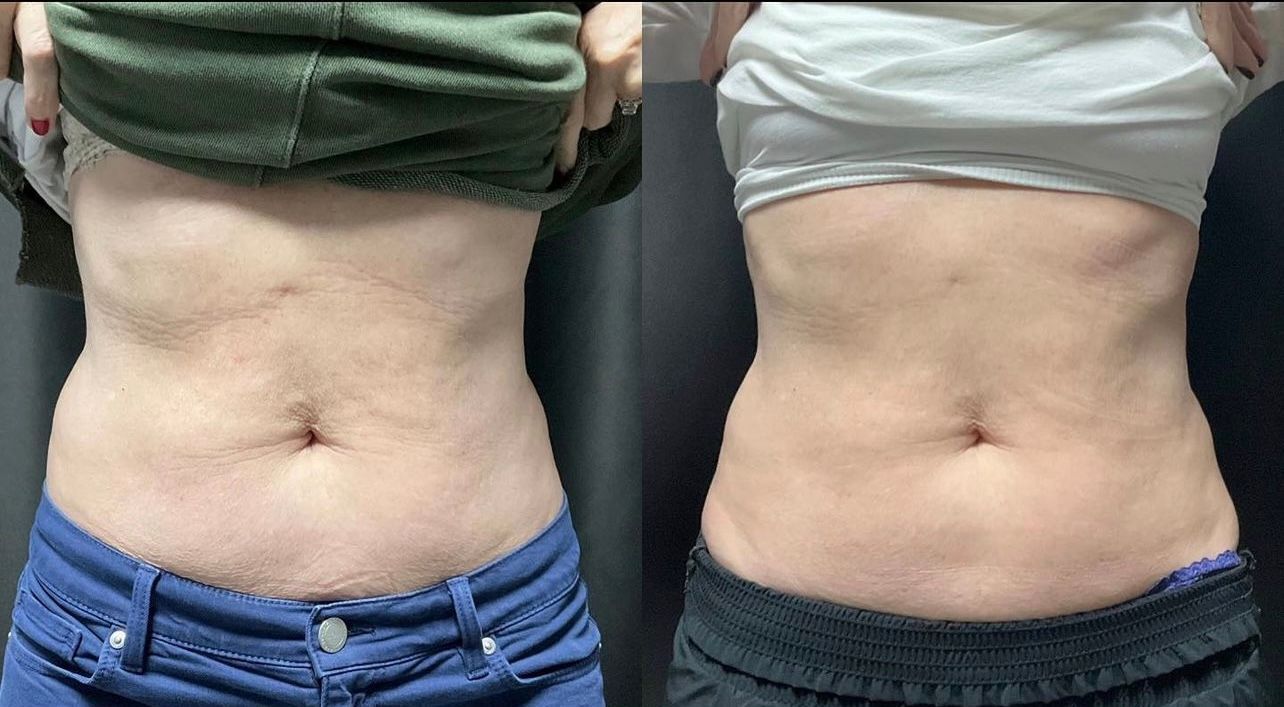 A before and after picture of a woman 's stomach.