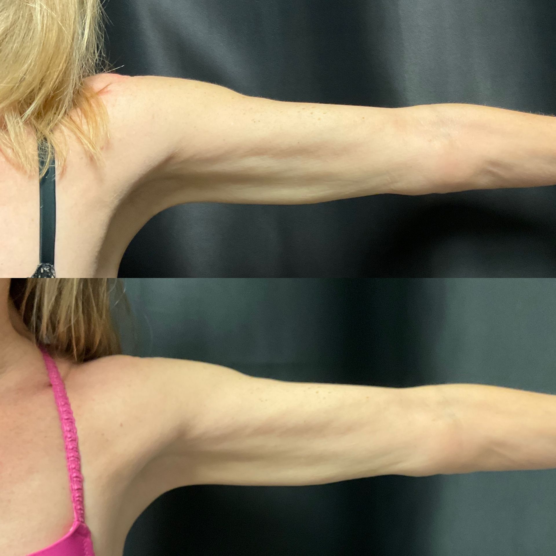 A before and after photo of a woman 's arm