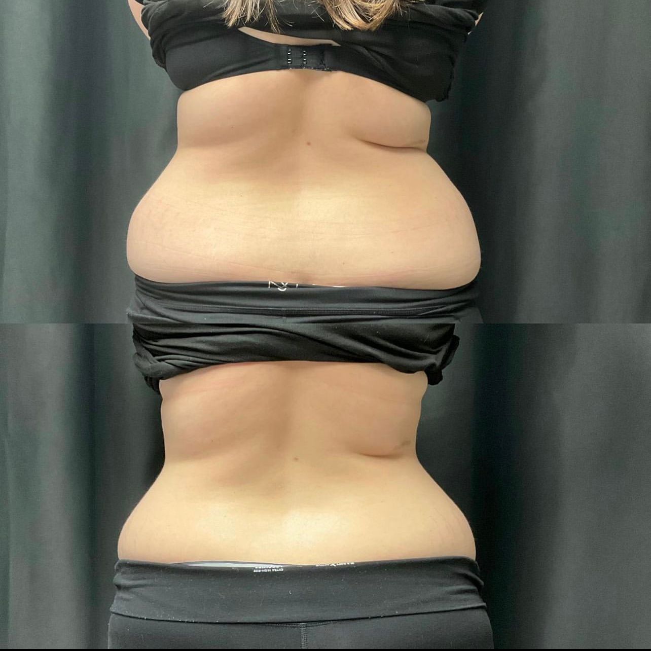 A woman 's back is shown in a before and after photo.