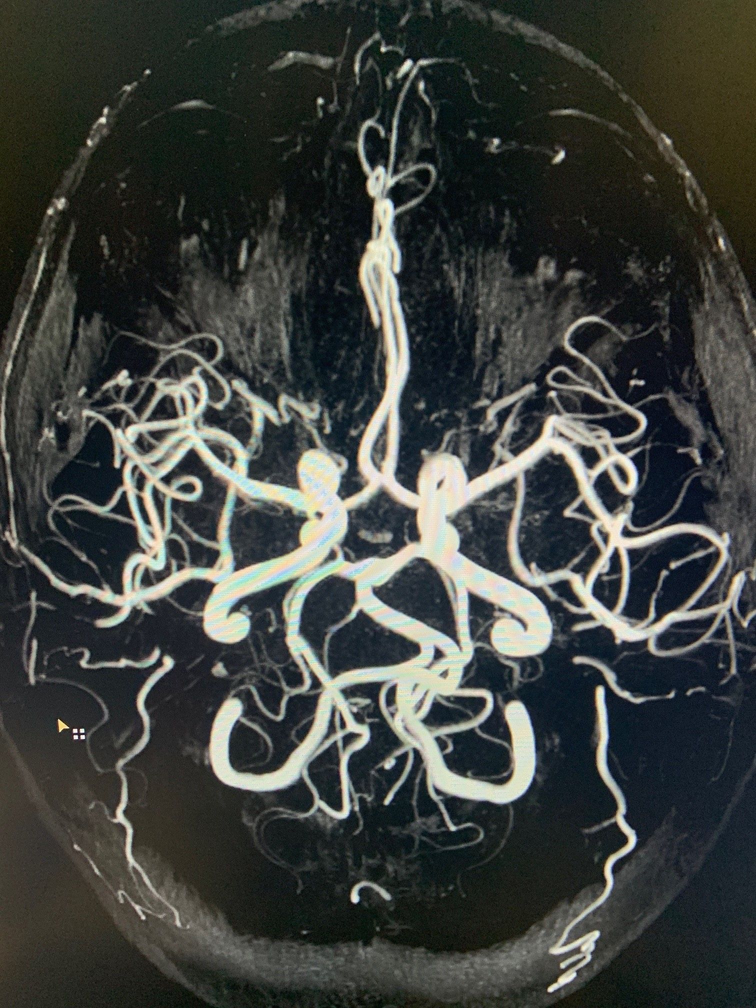 MRI Imaging Scan - Metairie, LA - Elite MRimaging