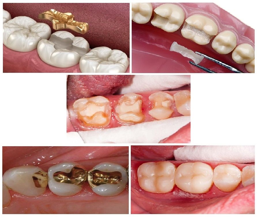 types of dental inlays 