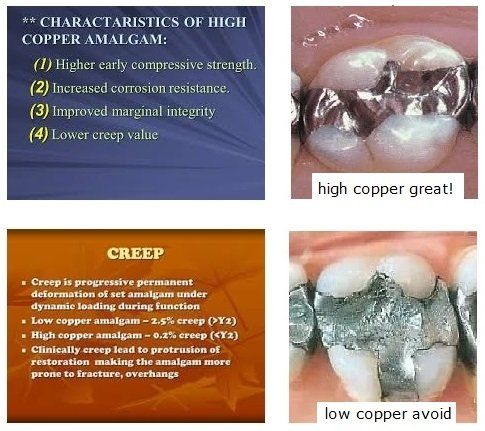 high copper amalgam, high qaulity amalgam verses low qaulity, dentist 33578 amalgam