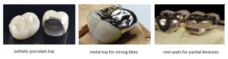 metal occusial top PFM dental crown