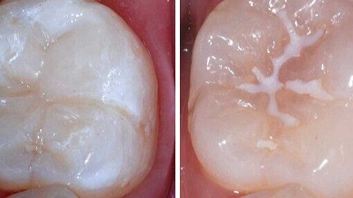 Dental Fissure sealants – Banyo QLD – Banyo Dental
