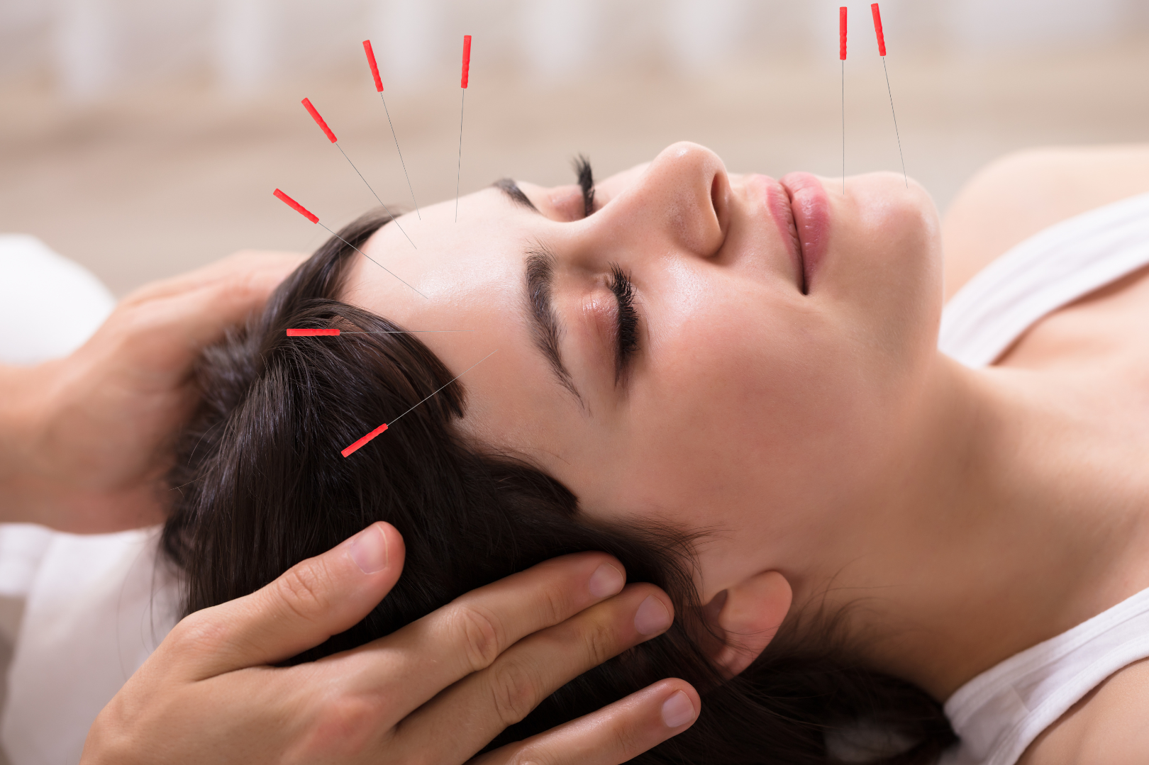 A woman is getting an acupuncture treatment on her head.