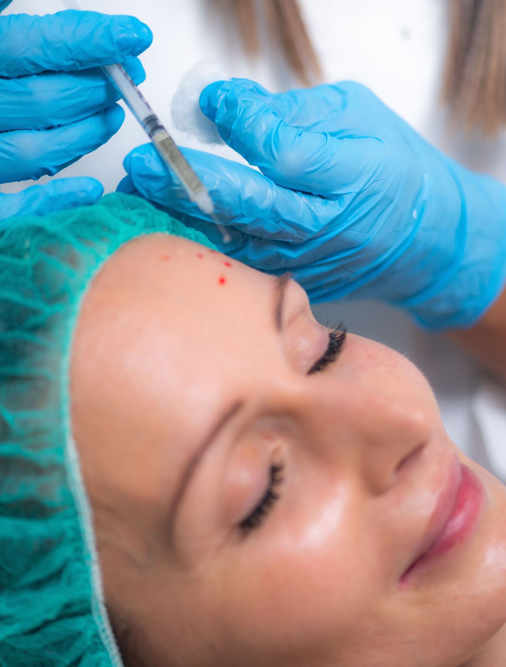 PRP skin rejuvenation treatment