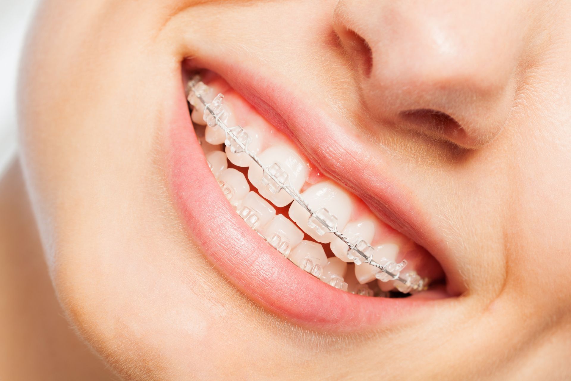 A close up of a woman 's smile with braces on her teeth.