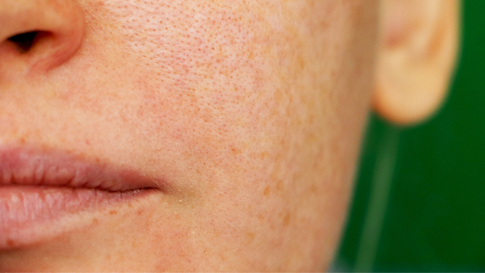 A close up of a woman 's face with clogged pores and a green background.