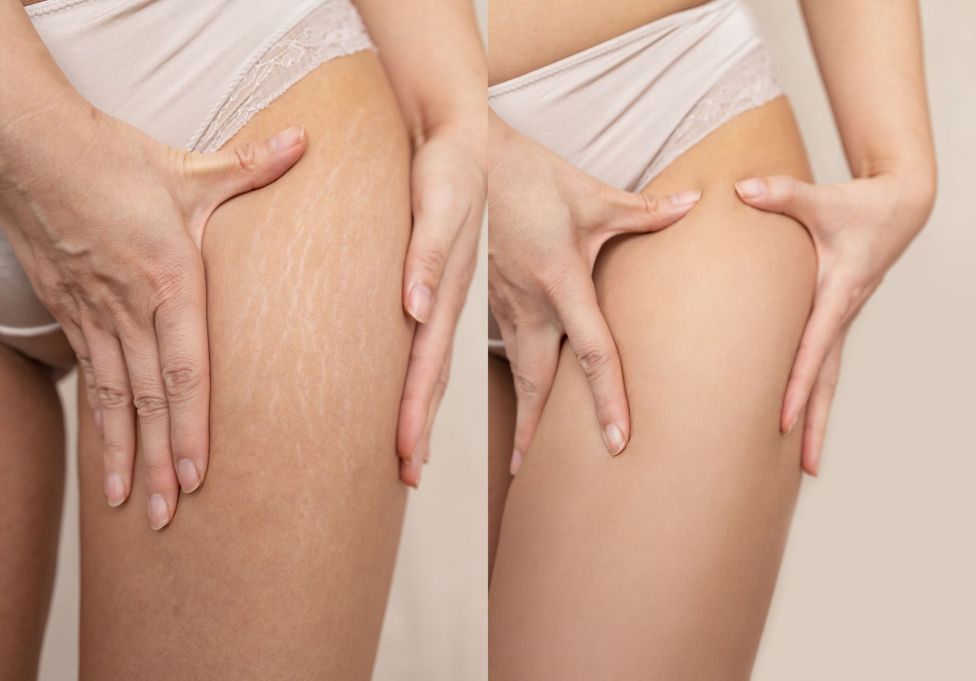 Comparison of a woman's thigh with stretch marks (left) and smoother skin (right).