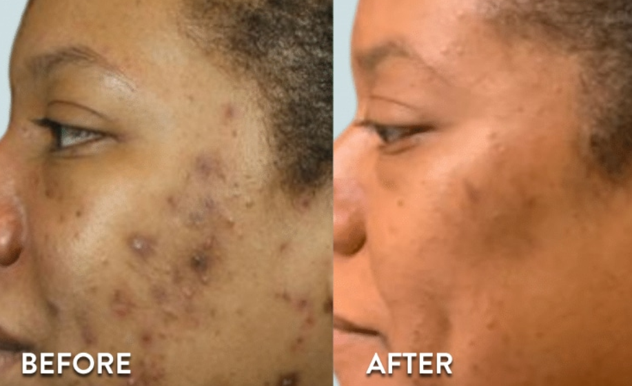 SKINCeuticals Pigment Balancing Peel- 3 Step- FULL SIZE