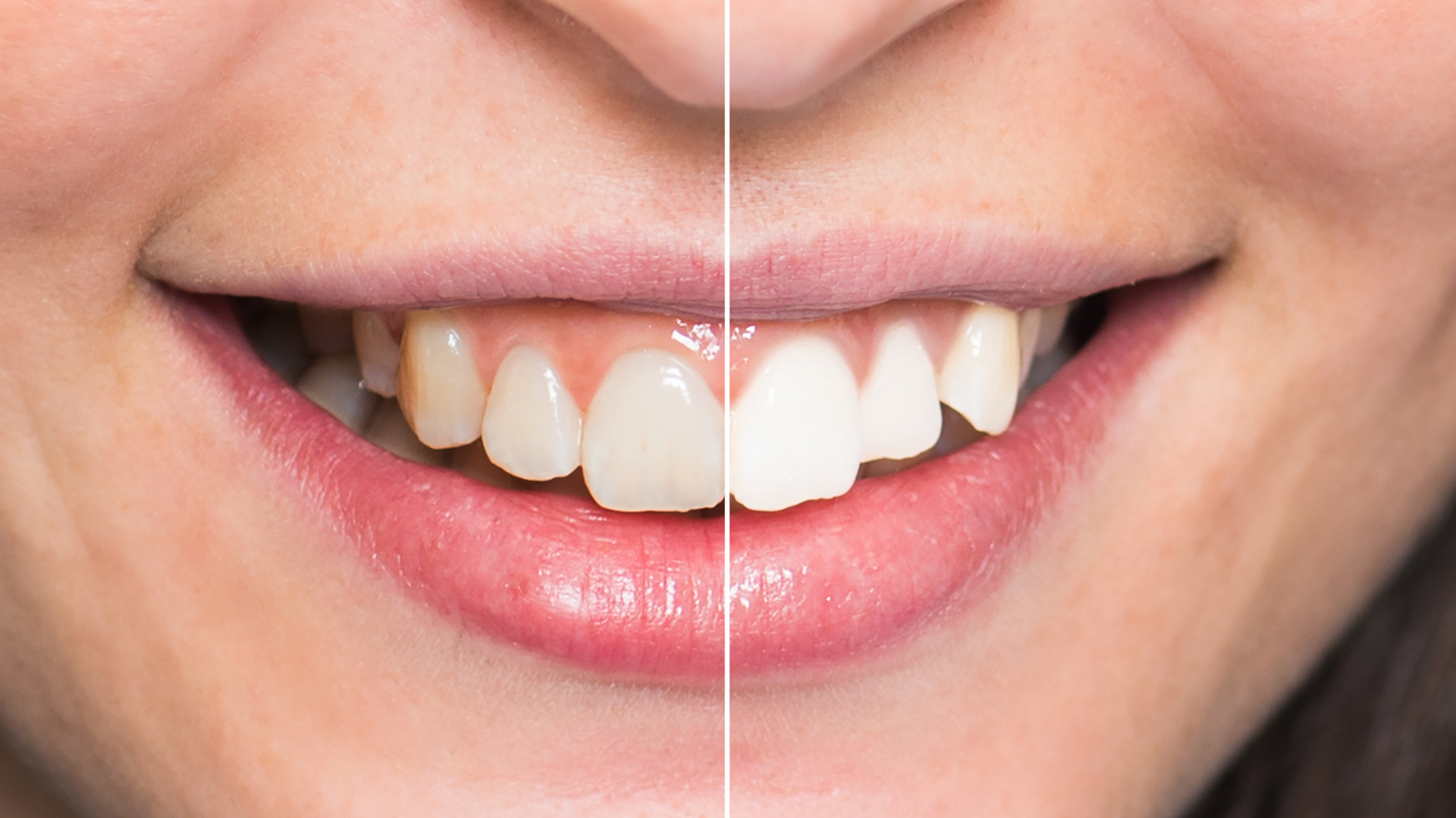 Side-by-side comparison of teeth: before and after whitening. Bright, white smile vs. duller teeth.