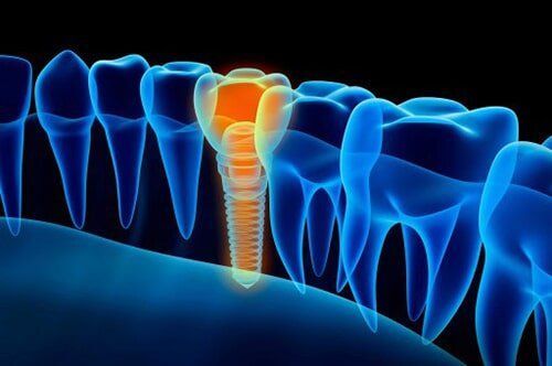 Implants — Dentures & Dental Implants in Bend, OR