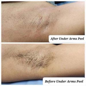 A before and after picture of under arms peel