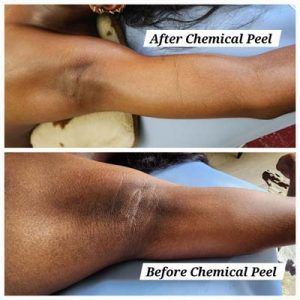 A woman 's arm before and after a chemical peel.
