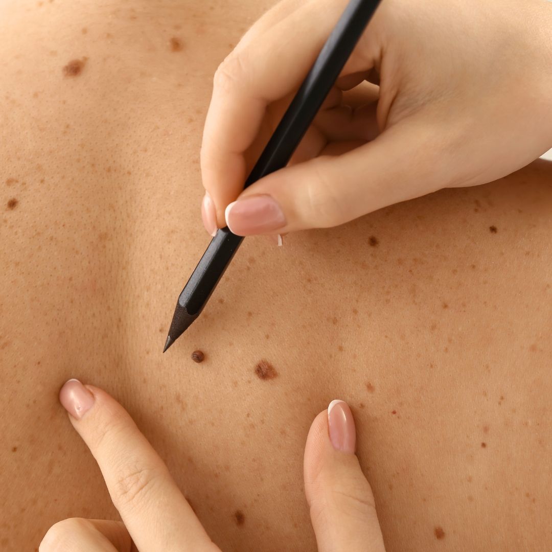 Doctor marks moles on a patient's back with a pencil, preparing for a procedure.