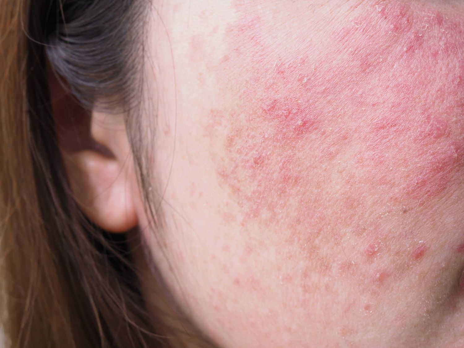 Person with a red, irritated skin rash covering parts of their face, near their ear.