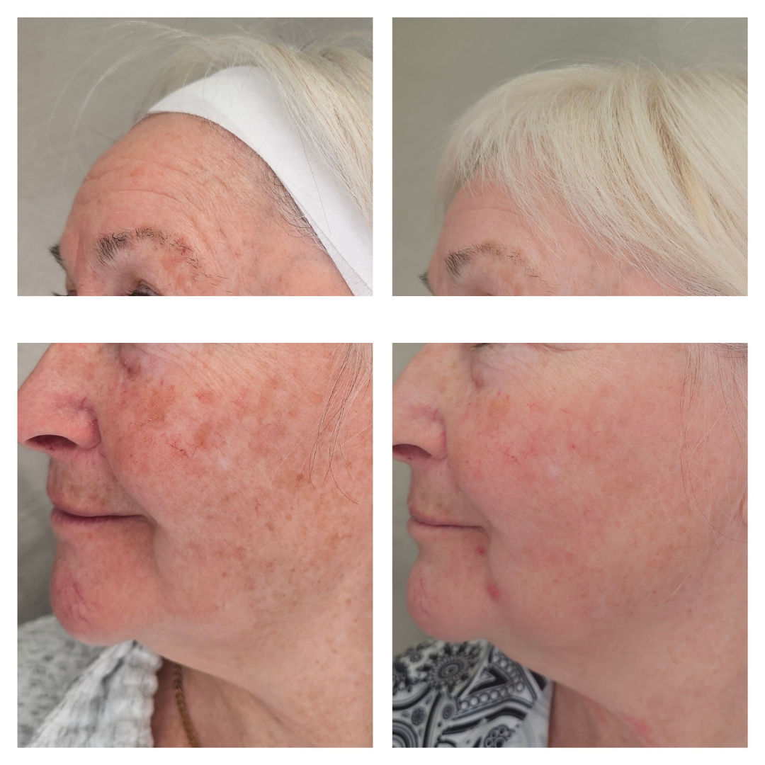 A before and after photo of a woman 's face