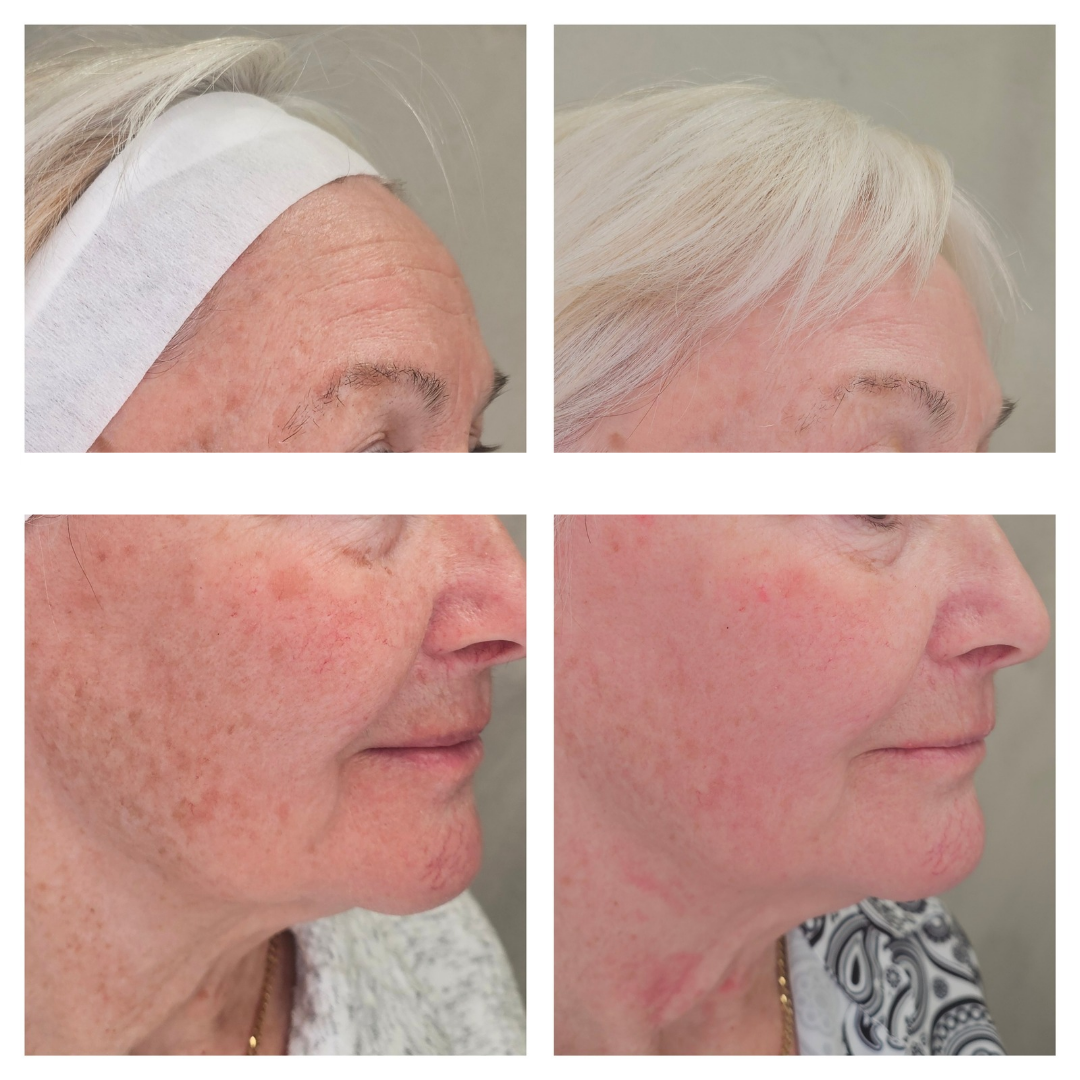 A before and after photo of a woman 's face