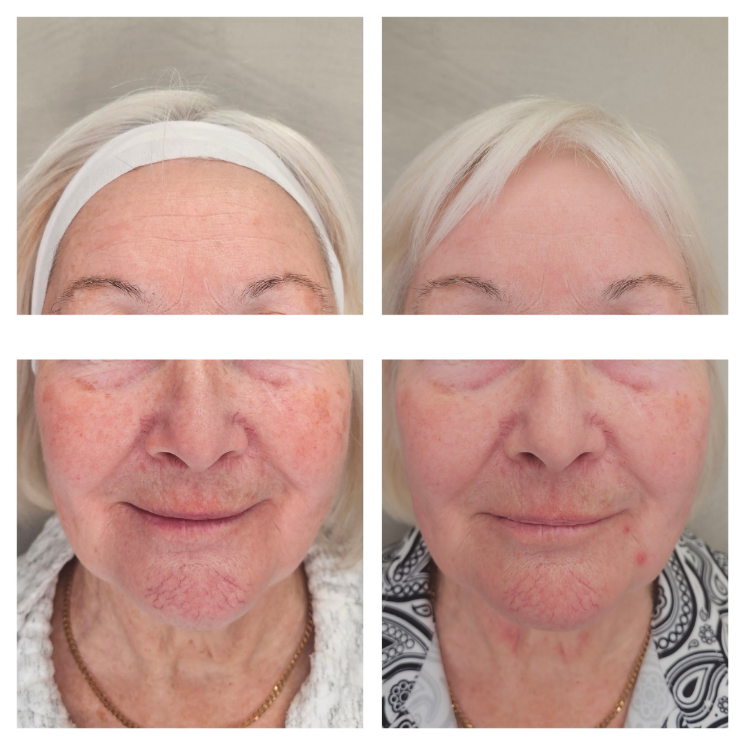 A before and after photo of a woman 's face