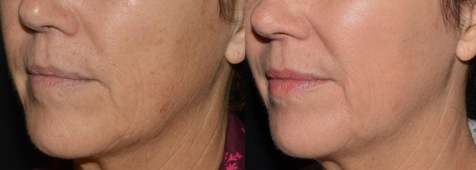 A before and after photo of a woman 's face.