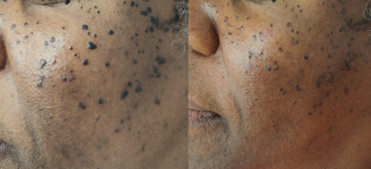 A before and after photo of a man 's face with black spots on it.