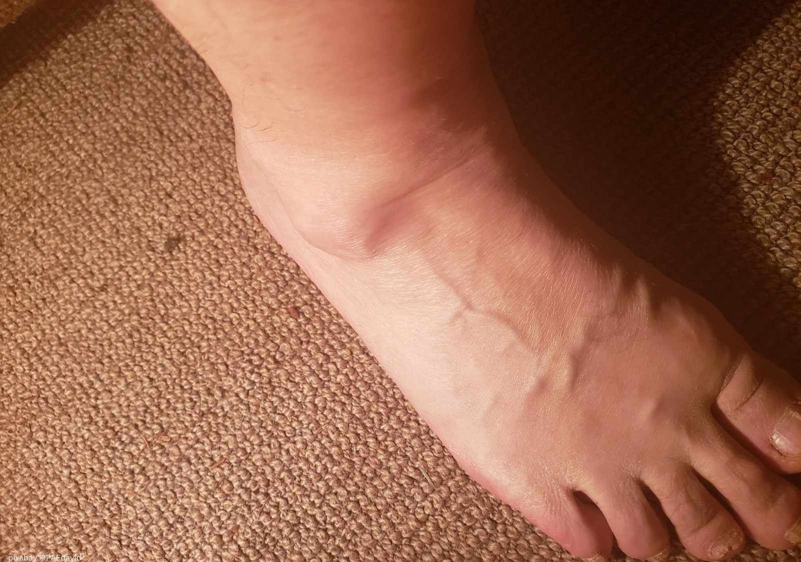 Fuß mit typischen Knebel bei Ganglion