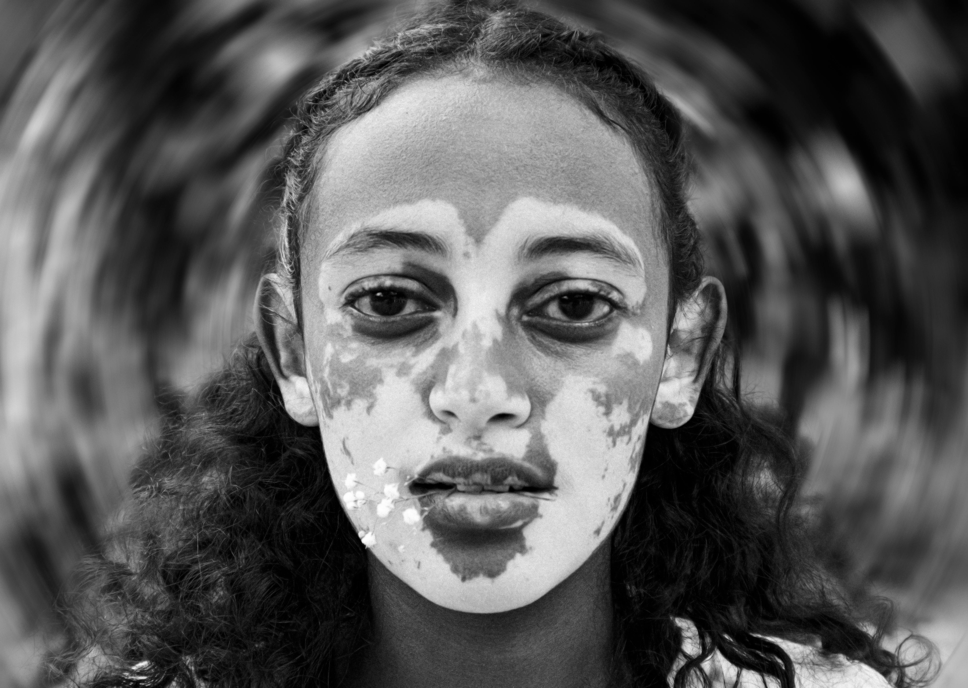 A person with vitiligo on their face, looking at the camera, blurred background.