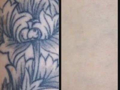 Tattoo Removal | Kentucky | Lexington Tattoo Removal