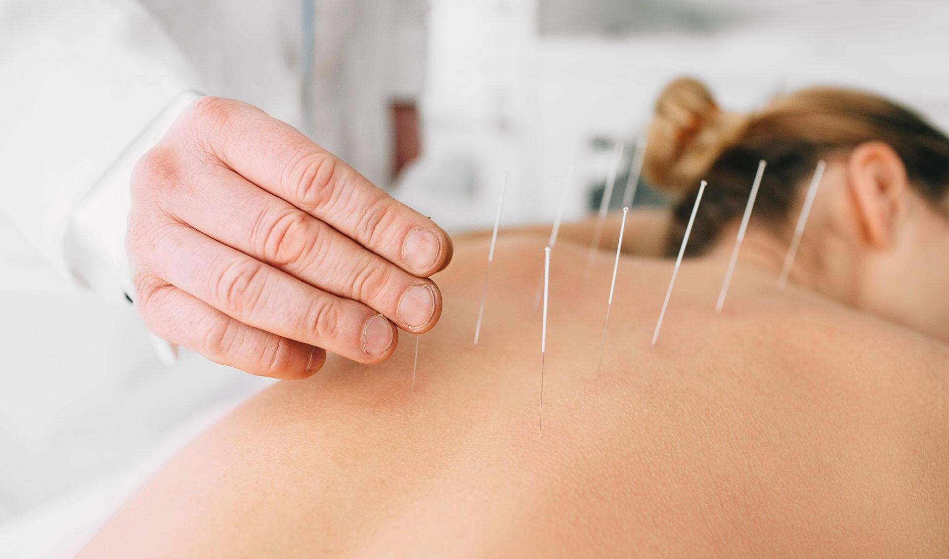 Acupuncture needles are placed along the upper back for pain relief therapy.