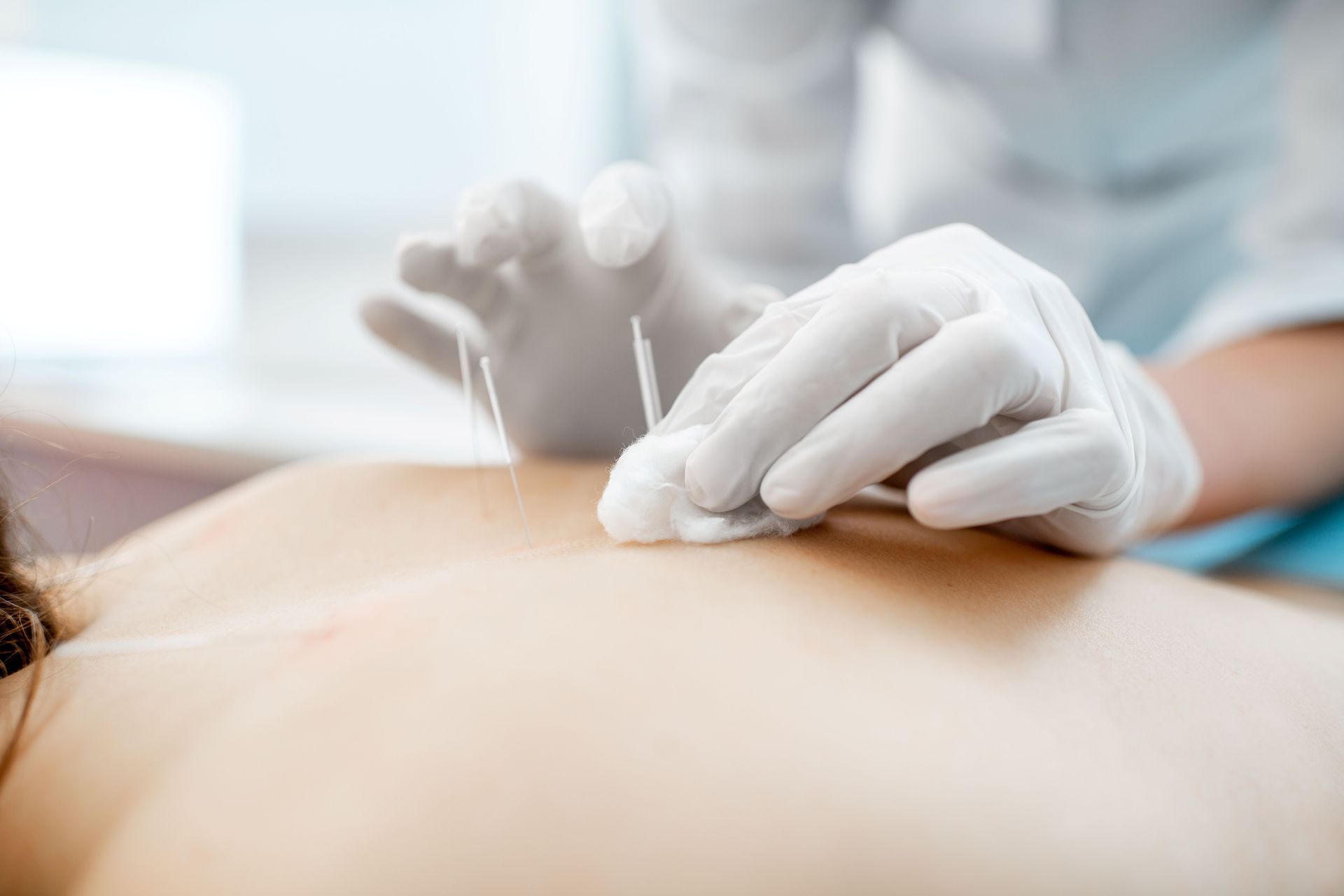 A person is getting acupuncture medical treatment.