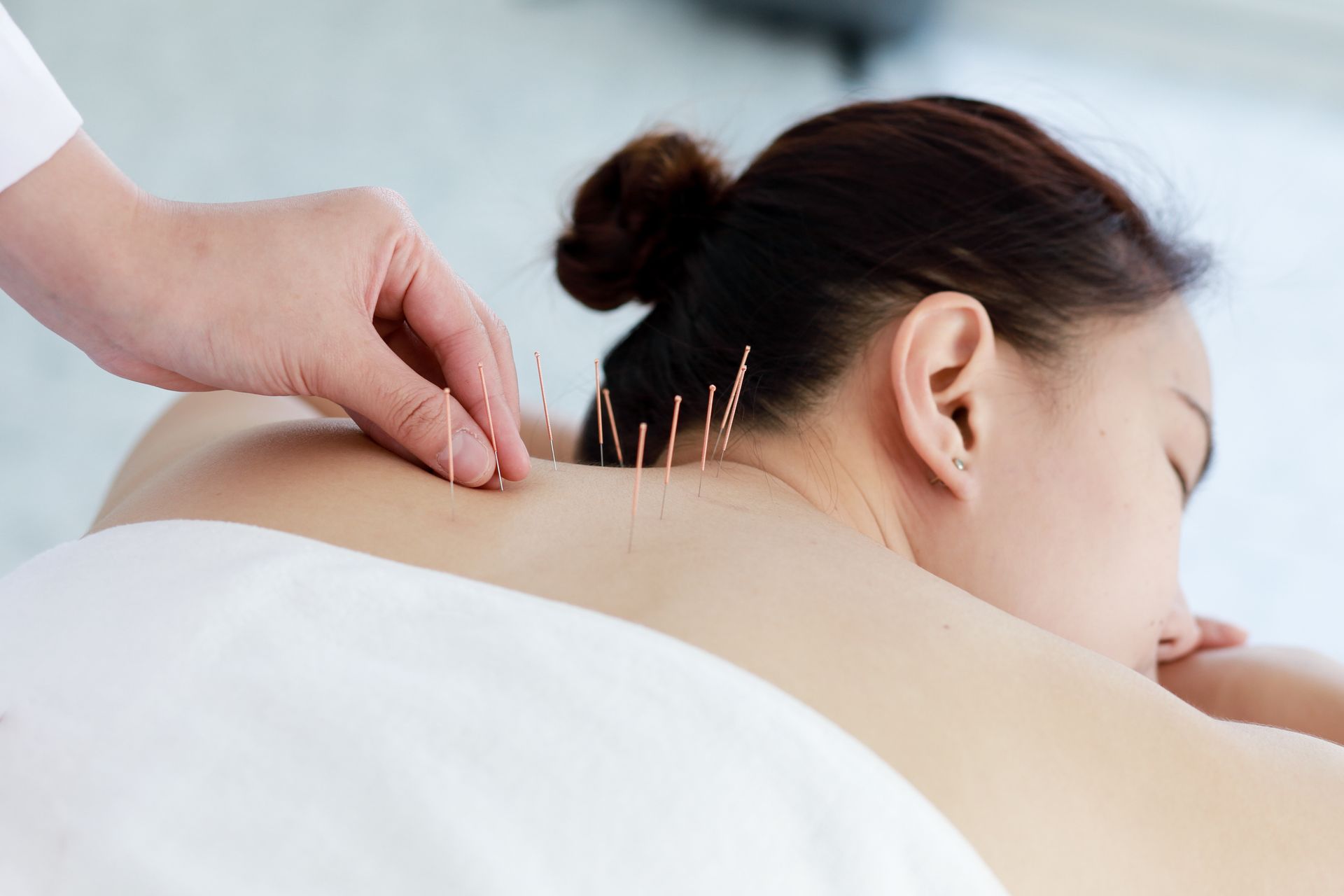 An acupuncture treatment with several thin needles inserted into the upper back by a practitioner