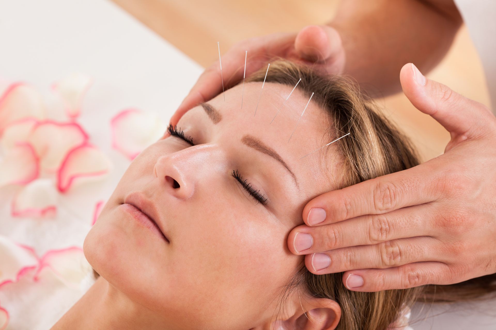 A woman is undergoing acupuncture treatment.