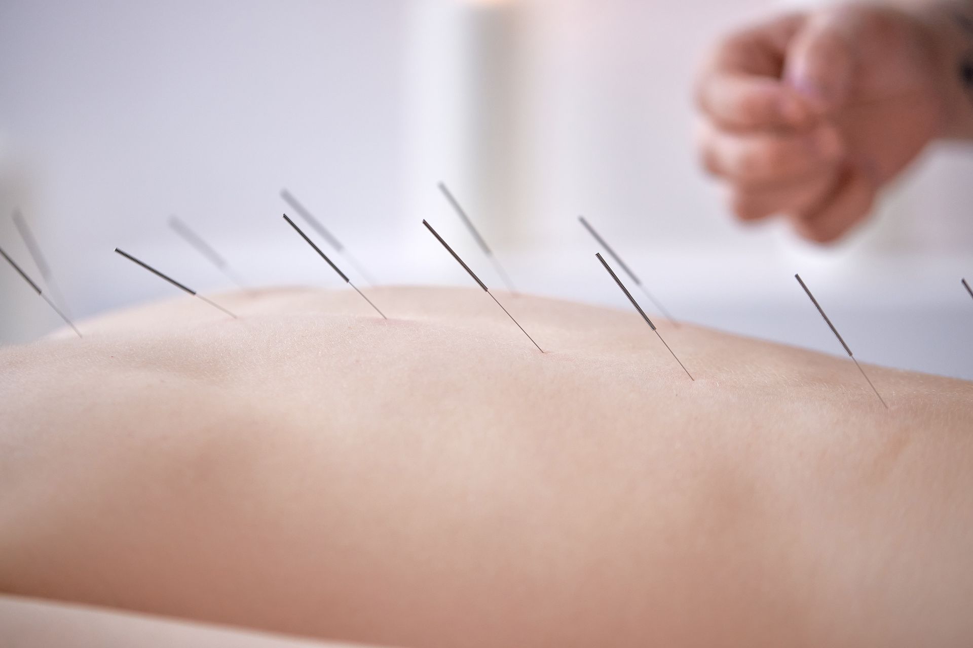 hand of professional doctor performing acupuncture therapy for female client.