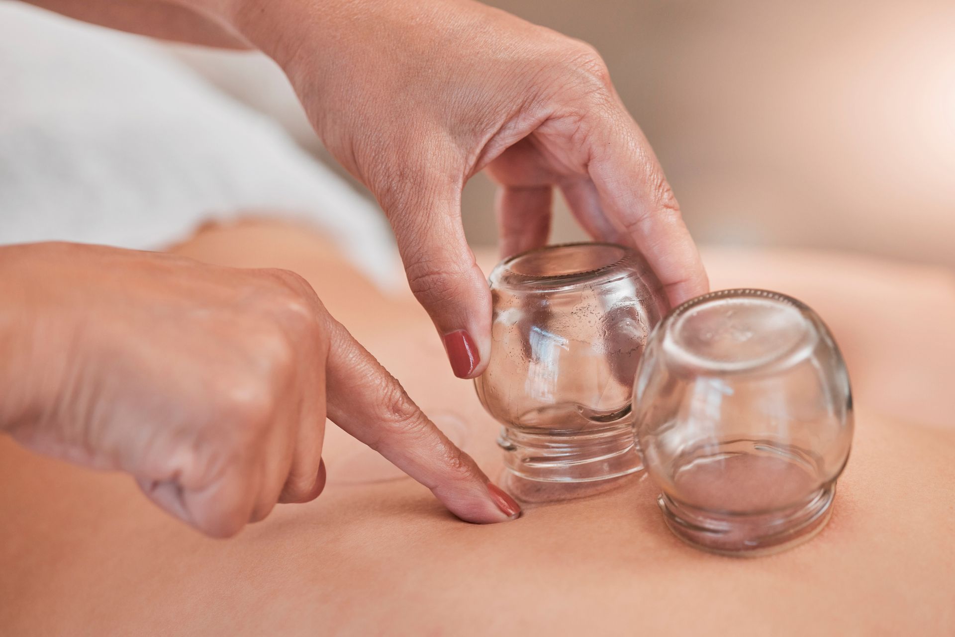 Hands placing glass cups on a person's back for cupping therapy.
