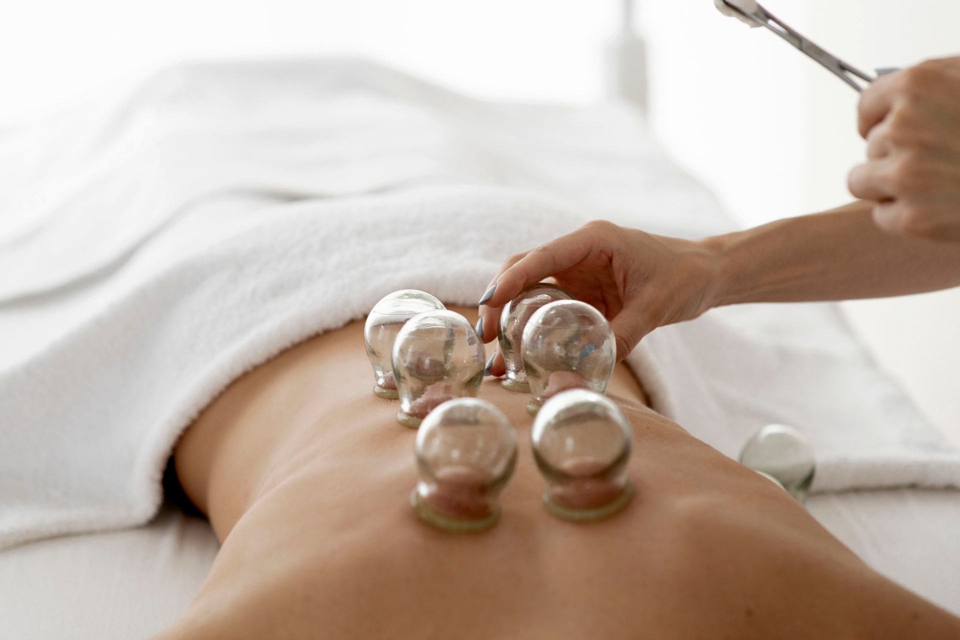 Person receiving cupping therapy on their back, clear glass cups attached.