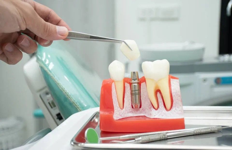 implantologia dentale