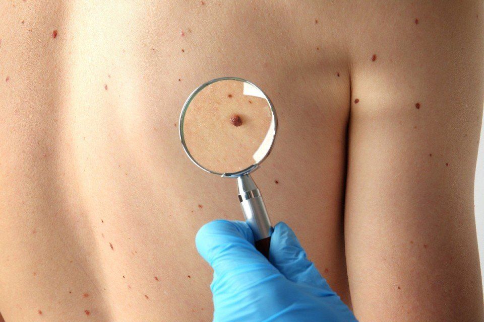 controllo dei nei e delle macchie della pelle