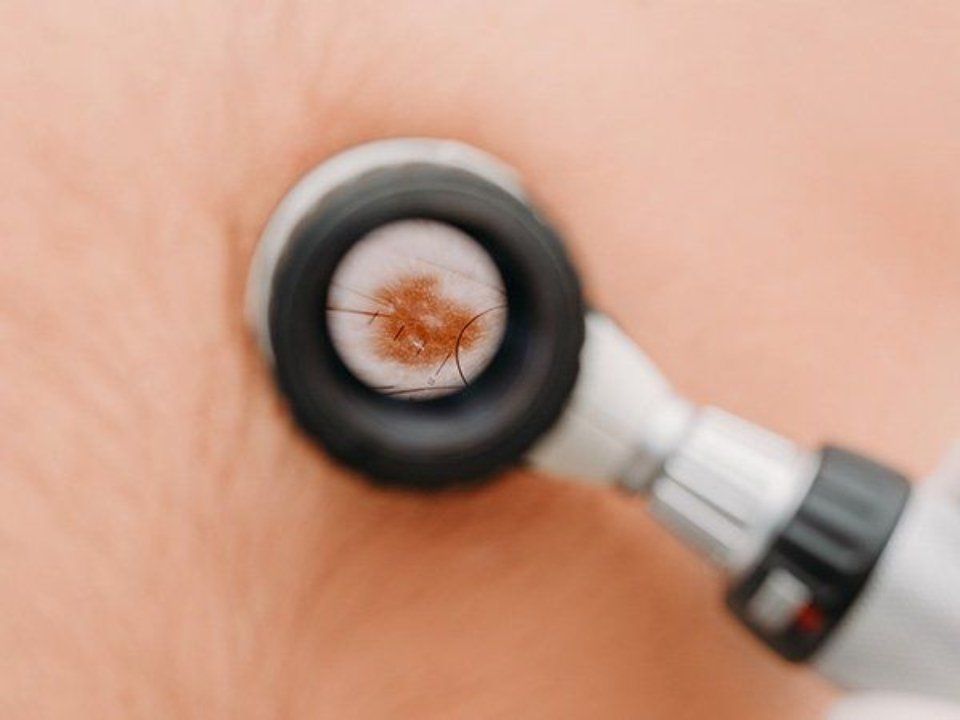 mappatura dei nei non dolorosa