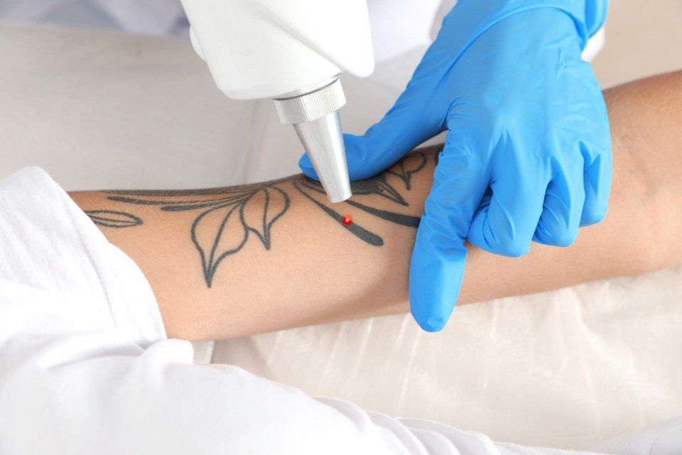 rimozione tatuaggi con laser