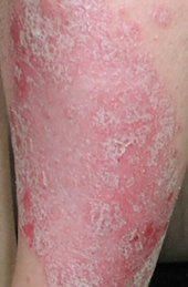 C. P. 19 Feb ’03 1 month treatment WG Spray