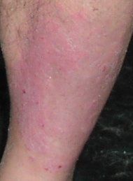 C. P. 19 Feb ’03 1 month treatment WG Spray