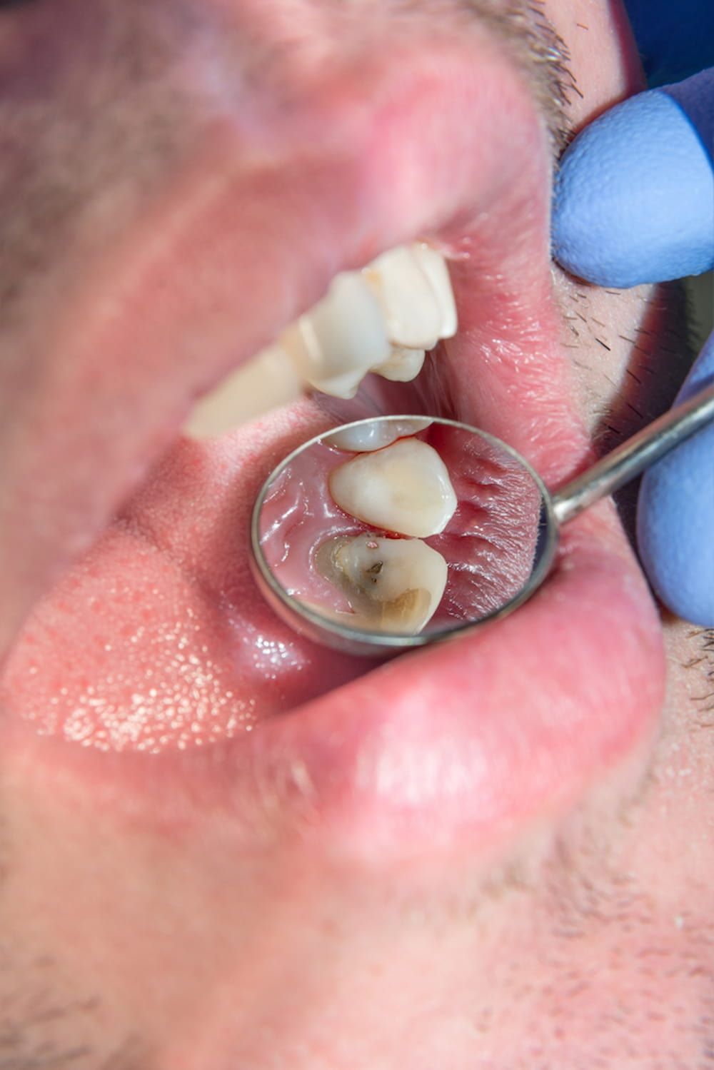 A Man is Getting His Teeth Examined by a Dentist — New Horizons Dental in Port Douglas, QLD