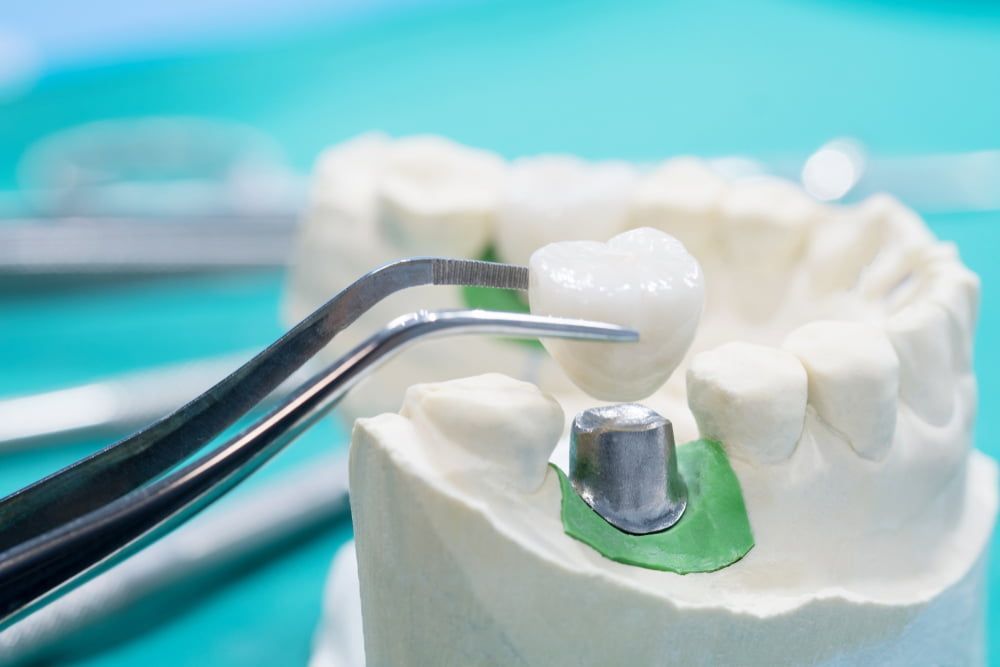 A Close Up of a Model of a Tooth With a Crown on It — New Horizons Dental in Port Douglas, QLD