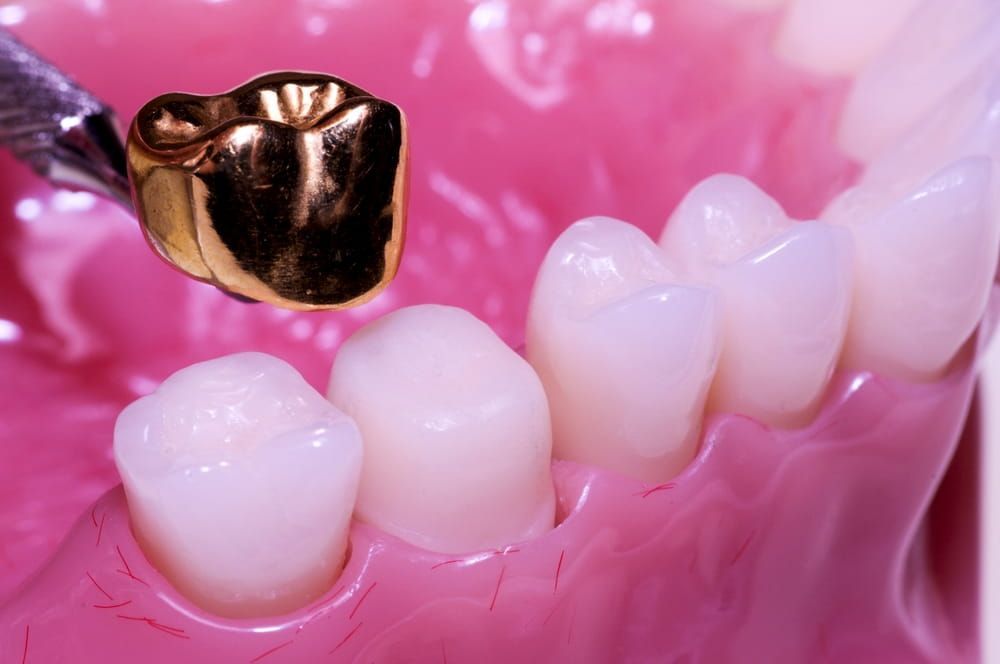 A Close Up of a Tooth With a Gold Crown on It — New Horizons Dental in Port Douglas, QLD