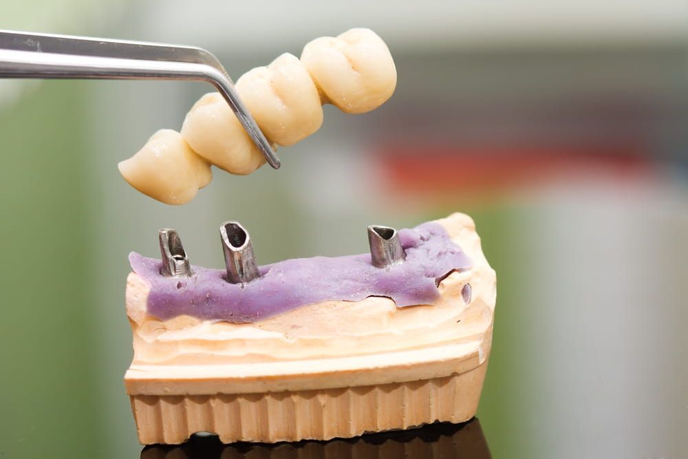 A Dental Bridge is Being Built on a Model of a Tooth — New Horizons Dental in Port Douglas, QLD