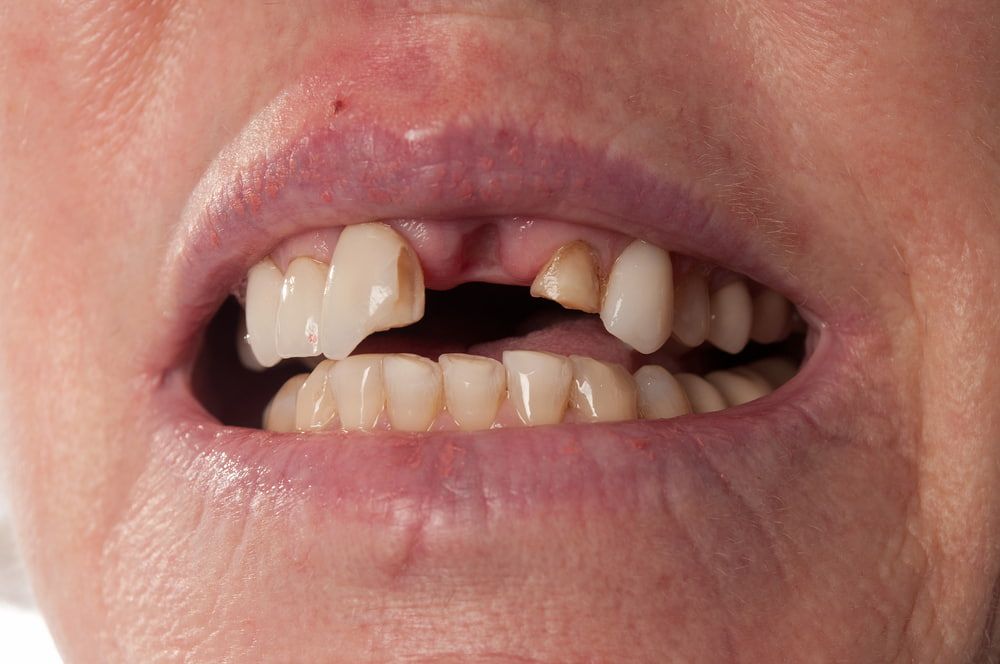 A Close Up of a Person's Mouth With Missing Teeth — New Horizons Dental in Port Douglas, QLD