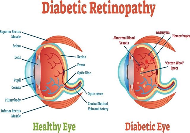 Understanding the Connection Between High Blood Sugar and Eye Diseases