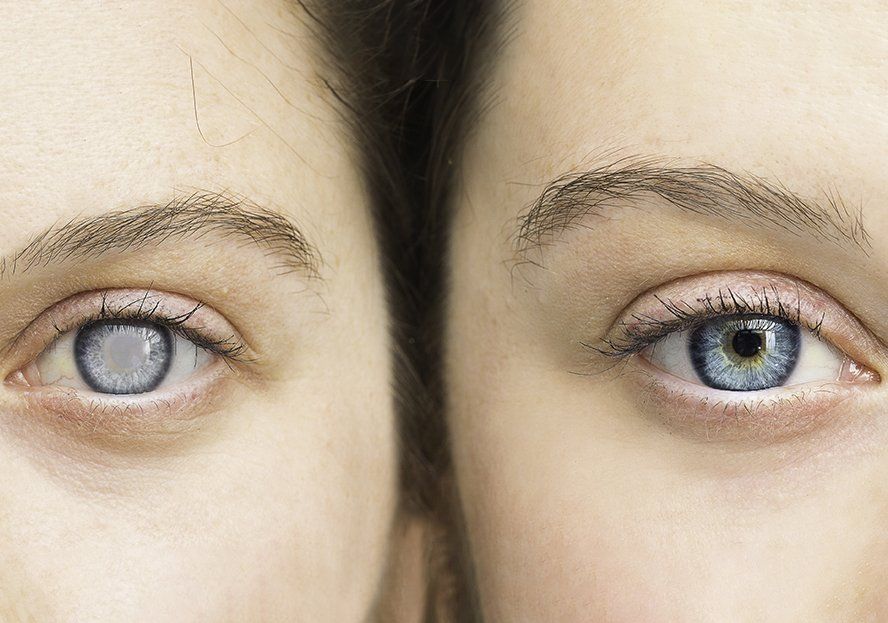 cataract surgery vs lasik