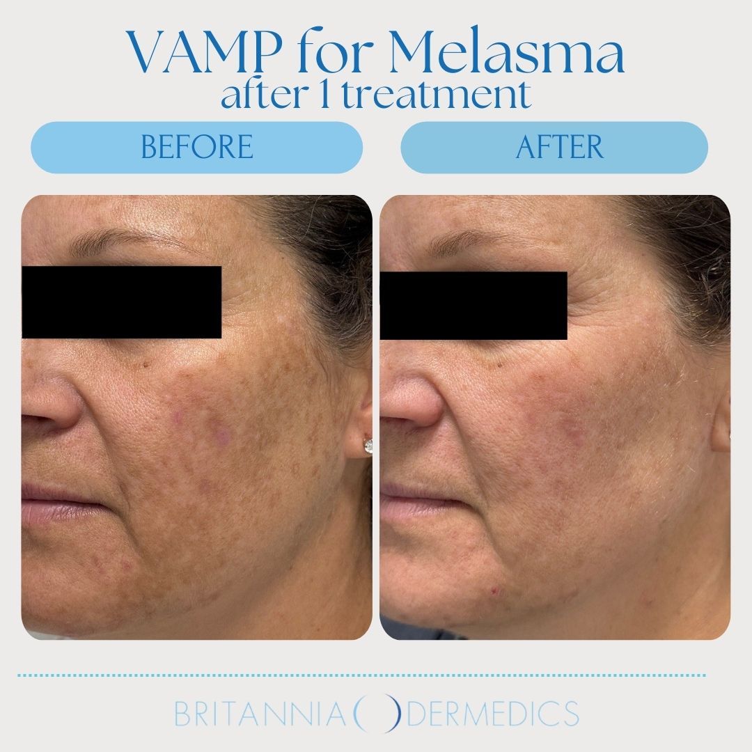 Before and after facial photo showing reduction of melasma after VAMP treatment.